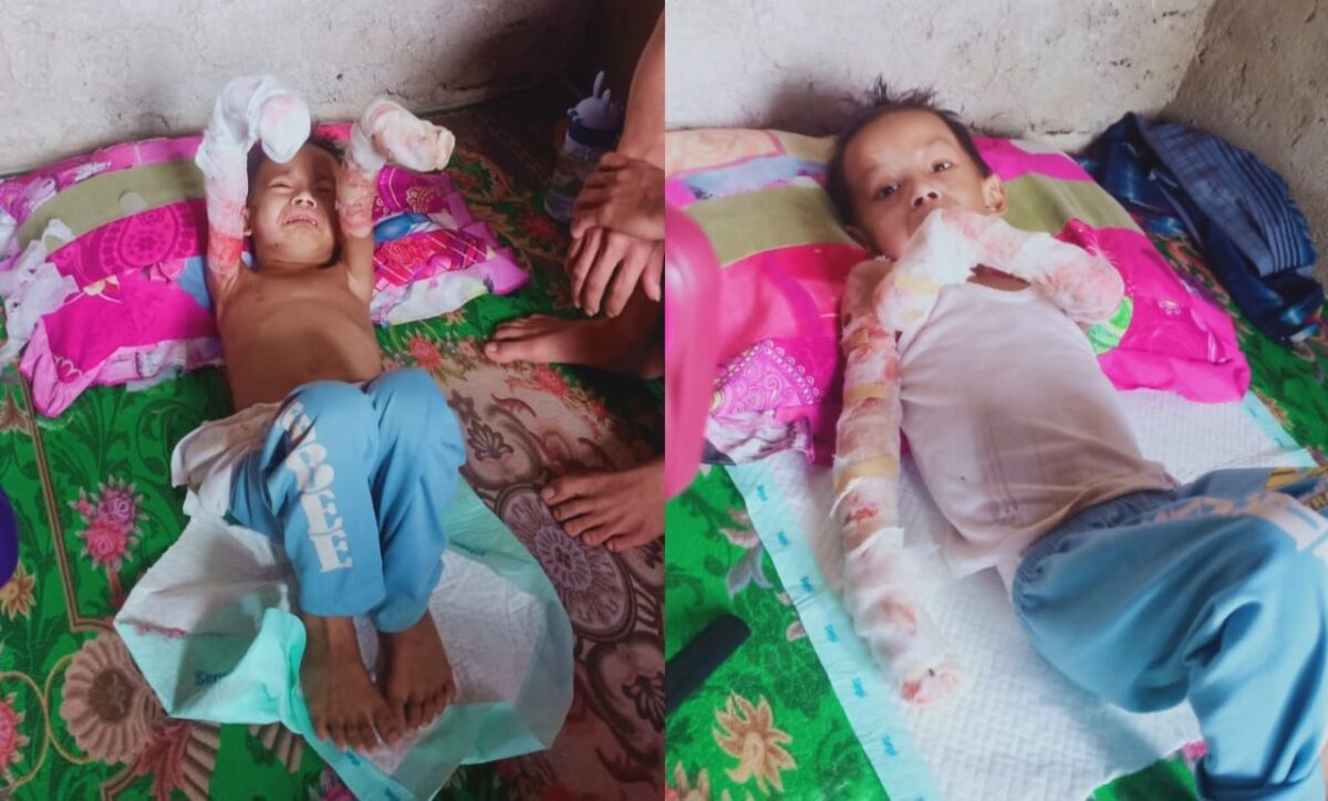 Kondisi bocah Azka warga Dusun Lubuk Kuyung Pekon Sukamulya Kecamatan Pugung paska sebulan tangannya masuk ke rebusan gula | Dok. Keluarga Azka.