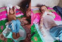 Kondisi bocah Azka warga Dusun Lubuk Kuyung Pekon Sukamulya Kecamatan Pugung paska sebulan tangannya masuk ke rebusan gula | Dok. Keluarga Azka.