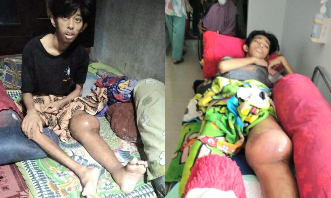 
 Kolase foto Dimas, Pelajar SMAN 1 Kota Agung Tanggamus yang divonis Kanker pada kaki kirinya | Dok. Keluarga Dimas.