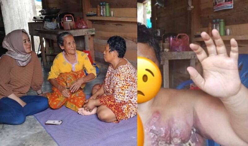 Kolase foto saat lurah Pasar Madang Mega Sari mengunjungi Hatimah dan kondisi kanker Hatimah yang sangat memprihatinkan, Sabtu 7 Desember 2024 | Herdi/Media Prioritastv.com.