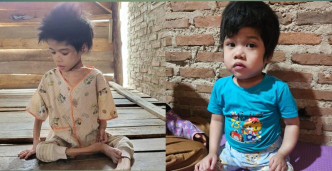 
 Kolese Foto Asiamah (7) Bocah Perempuan Penyandang Disabilitas (Foto Kiri Sebelum Asiamah Dirawat Oleh LKS Alamanda), (Foto Kanan Asiamah Sesudah Dirawat Oleh LKS Alamanda). Asrul Ariski/Media Prioritastv.com. 
